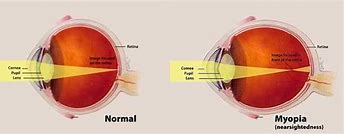 Image result for Myopia Eye Drops