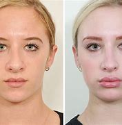 Image result for Rhinoplasty Nose Surgery