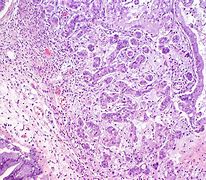 Image result for Mucinous Borderline Tumor Ovary
