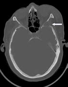 Image result for Sphenoid Encephalocele