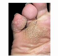 Image result for Mosaic Warts On Feet