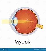 Image result for Myopia Drawing