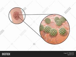 Image result for السنط الجلدي Papillomaviruses