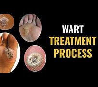 Image result for Molluscum Warts Treatment