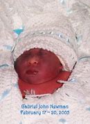 Image result for Longest Living Anencephaly Baby