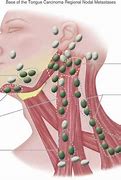Image result for Metastatic Head and Neck Cancer