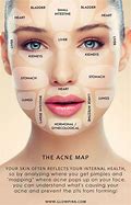 Image result for Face Mapping Acne