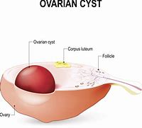 Image result for How Big Is a 2 Cm Cyst