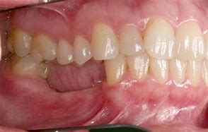 Image result for Jawbone Deterioration