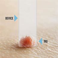 Image result for DIY Remove Skin Tags