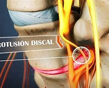 Image result for discal