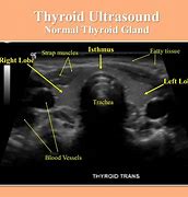 Image result for Thyroid Gland Ultrasound