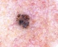 Image result for Pigmented Basal Cell Carcinoma Dermoscopy
