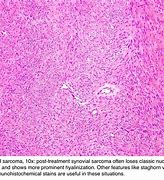 Image result for Synovial Sarcoma