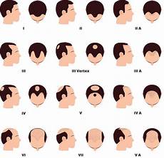 Pattern Baldness Surgical And Natural Treatments
