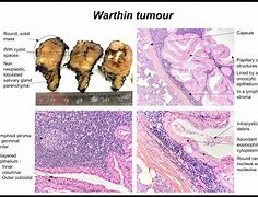 Image result for Warthin's Tumor Parotid Gland