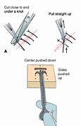 Image result for Staple and Suture Removal