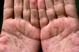 Image result for HPV Skin Rash