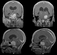 Image result for Skull Base Meningioma Brain Tumor