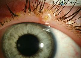 Image result for Molluscum Contagiosum Eye