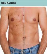 Image result for Kidney Failure Skin Rash