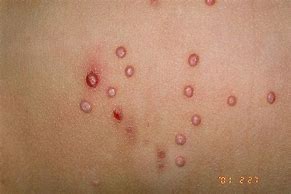 Image result for Inflamed Molluscum Contagiosum