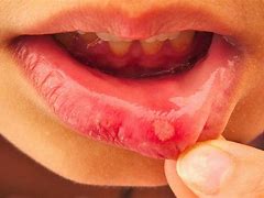 Image result for Lip Sore Outer Carton