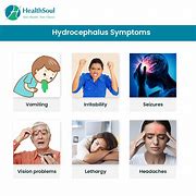 Image result for Hydrocephalus Signs and Symptoms