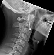 Image result for Anterior C2 Odontoid Screw Placement