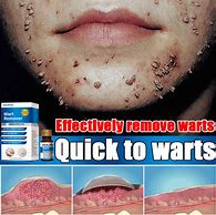 Image result for Water Warts Cream