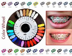 Image result for Good Braces Colors