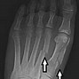Image result for Stress Fracture Metatarsal Radiology