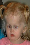 Image result for Holoprosencephaly