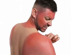 Image result for Bad Sunburn