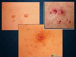 Image result for Acute Genital Ulcers