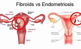 Image result for Fibroids vs Endometriosis