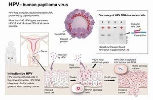 Image result for HPV Cervical Cancer