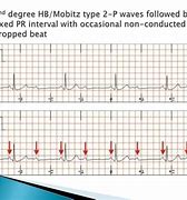 Image result for Mobitz Type 2 versus Non Conducted P Waves