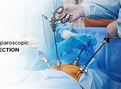 Image result for Laparoscopic Liver Surgery