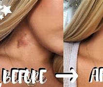 Image result for What Color Is a Hickey