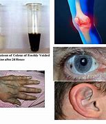 Image result for alcapronuria