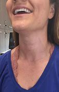 Image result for Thyroid Cancer After Surgery