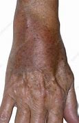 Image result for Bruised Wrist
