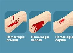 Image result for Clasificacion Hemorragia