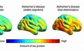 Image result for Memory Loss Brain