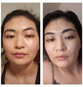 Image result for Tretinoin Cream 0.025 Before and After