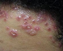 Image result for Wrestling Skin Infections