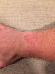 Image result for Rash On Wrist