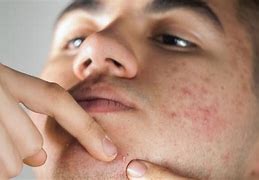 Image result for Small Pimple Popping