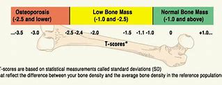 Image result for Osteoporosis Scale